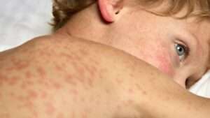 Measles Outbreak Alert in Hanoi